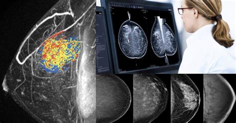 PHOTO GALLERY: What does breast cancer look like on .